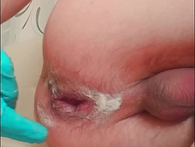 handsome skinny twink with splintered prolapse makes fisting to himself gay korean boy porn